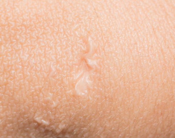 istock scar on the human skin 873586680