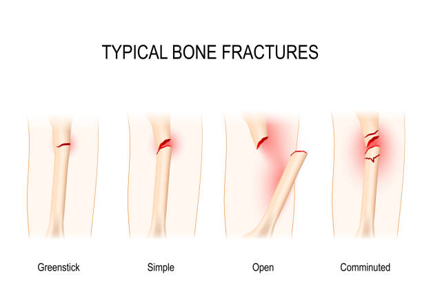 typische bone brüche - knochenbruch stock-grafiken, -clipart, -cartoons und -symbole