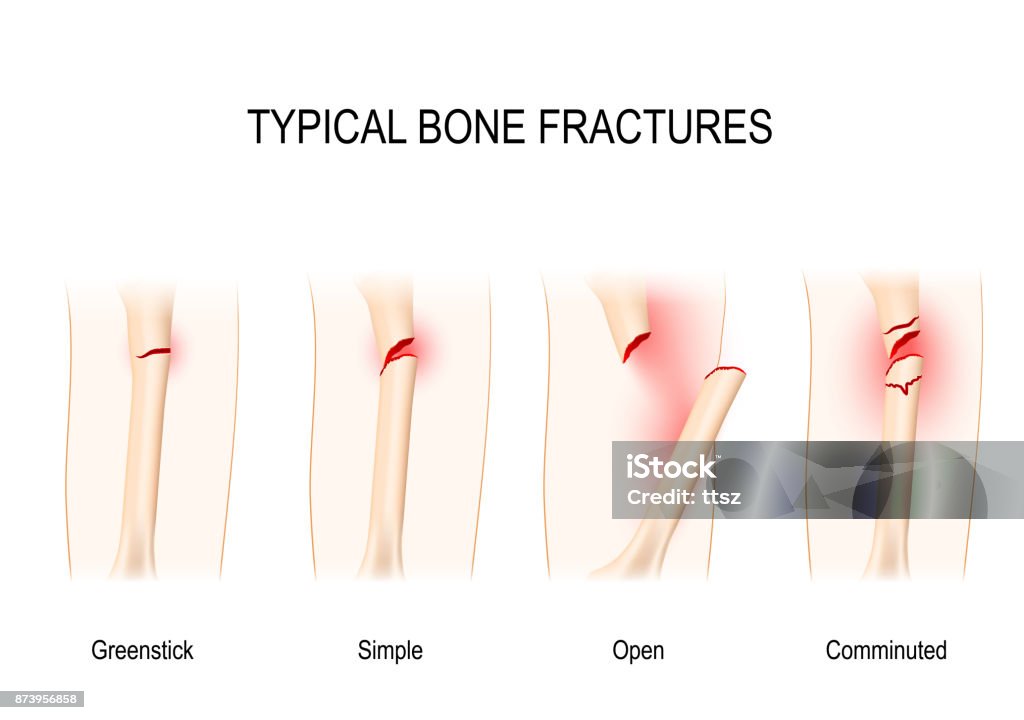 Typical bone fractures Typical bone fractures: Greenstick, Simple, Open, Comminuted. Vector scheme for medical use Bone Fracture stock vector