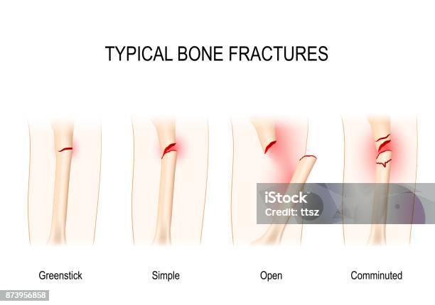 Typical Bone Fractures Stock Illustration - Download Image Now - Bone Fracture, Bone, Broken