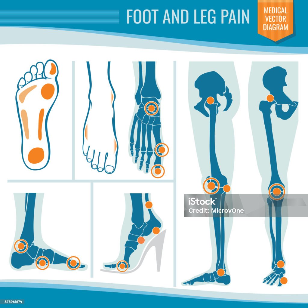 Foot and leg pain. Arthritis and rheumatism orthopedic medical vector diagram Foot and leg pain. Arthritis and rheumatism orthopedic medical vector diagram. Illustration of rheumatism leg joint Icon Symbol stock vector