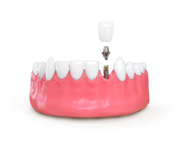 istock tooth dental implant model 874115100
