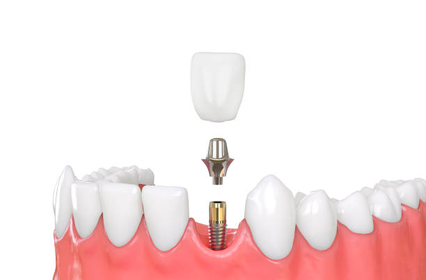 istock jaw model tooth implant 874115116