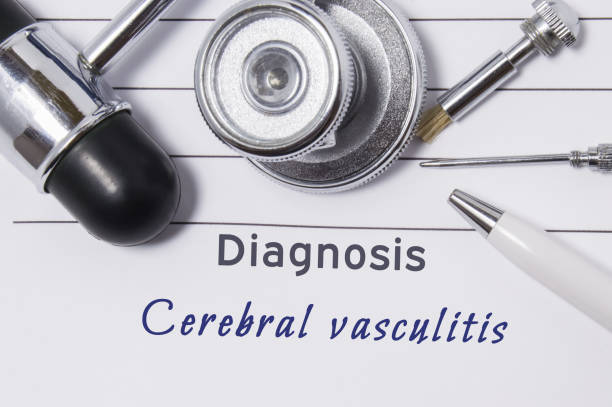 diagnosis de la vasculitis cerebral. declaración de médico con diagnóstico de vasculitis cerebral es en trabajo del neurólogo, estetoscopio, martillo y herramientas para determinar la sensibilidad - human artery audio fotografías e imágenes de stock