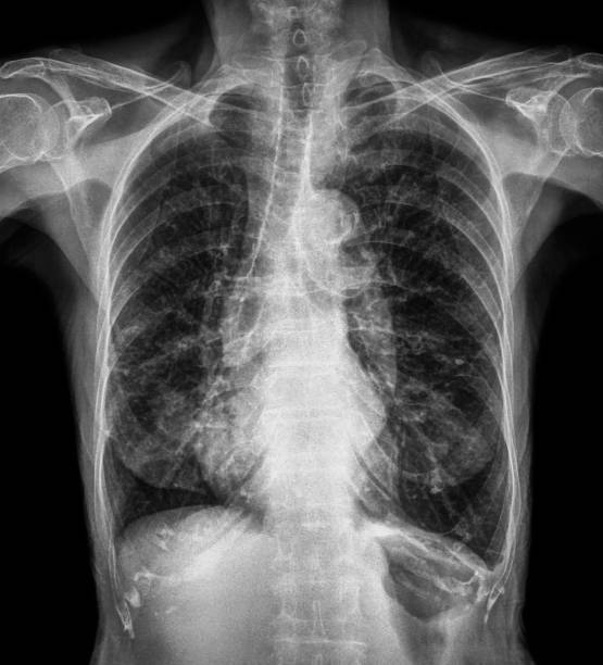 Normal chest X-ray of old patient . You can seen calcification at rib , trachea , bronchus . Front view Normal chest X-ray of old patient . You can seen calcification at rib , trachea , bronchus . Front view . chest torso photos stock pictures, royalty-free photos & images