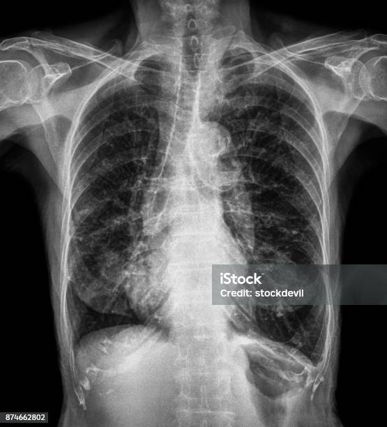 Normal Chest Xray Of Old Patient You Can Seen Calcification At Rib Trachea Bronchus Front View Stock Photo - Download Image Now