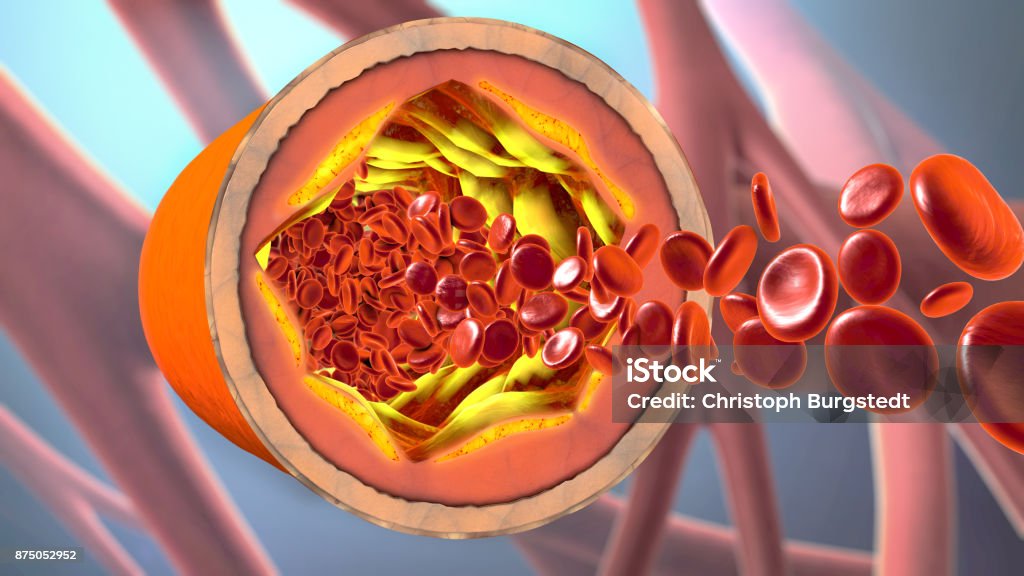 3d illustration of a precipitated and narrowing blood vessels or arteriosclerosis Artery Stock Photo
