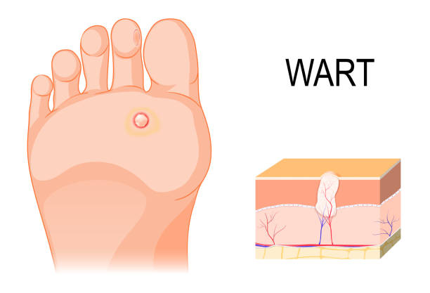 Foot warts on the bottom of soles and toes. Cross section of a common wart. Foot warts on the bottom of soles and toes. Cross section of a common wart. Illustration showing the characteristic features (hyperkeratosis, acanthosis, hypergranulosis and large blood vessels). wart stock illustrations