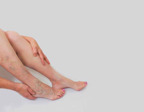 Varicose veins on a female legs The varicose veins on a legs of old woman on gray varicose vein stock pictures, royalty-free photos & images