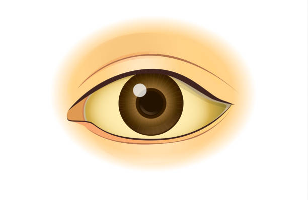 Yellowing in the human eye. Yellowing in the human eye. Illustration about symptom from digestion problem. hepatitis stock illustrations