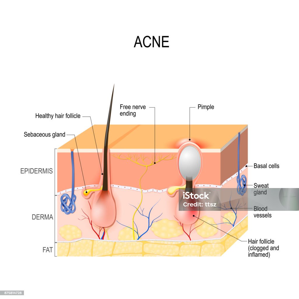 Acne vulgaris or pimple. healthy hair follicle and clogged pore. Acne vulgaris or pimple. healthy hair follicle and clogged pore. The sebum and dead skin cells in the clogged pore promotes the growth of a certain bacteria. This leads to the redness and inflammation associated with pimples. skin disease Skin stock vector