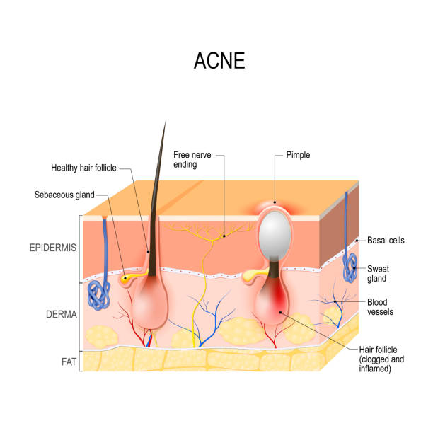 Acne Vulgaris Or Pimple Healthy Hair Follicle And Clogged Pore Stock Illustration - Download Image Now - iStock Acne Vulgaris Or Pimple Healthy Hair Follicle And Clogged Pore Stock Illustration - Download Image Now - iStock