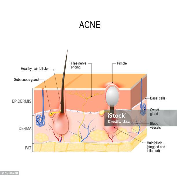 Acne Vulgaris Or Pimple Healthy Hair Follicle And Clogged Pore Stock Illustration - Download Image Now
