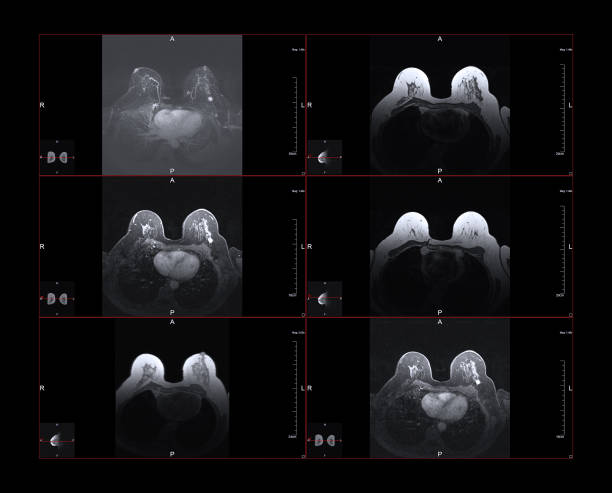 brustkrebs mri - mammogram mri scan breast breast examination stock-fotos und bilder