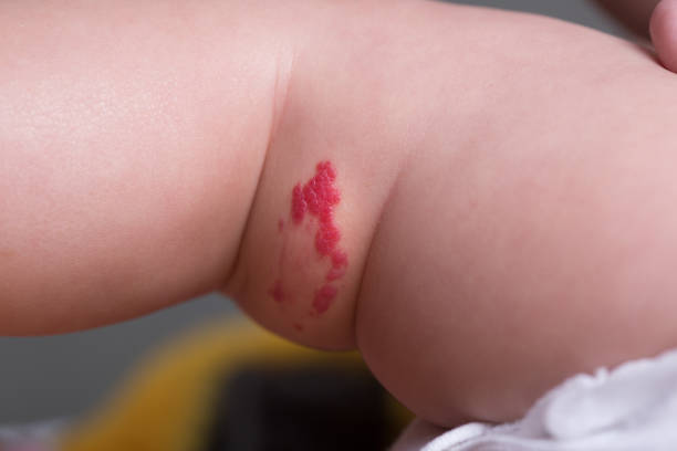 istock Capillary hemangioma red birthmark on the babys leg 876045156