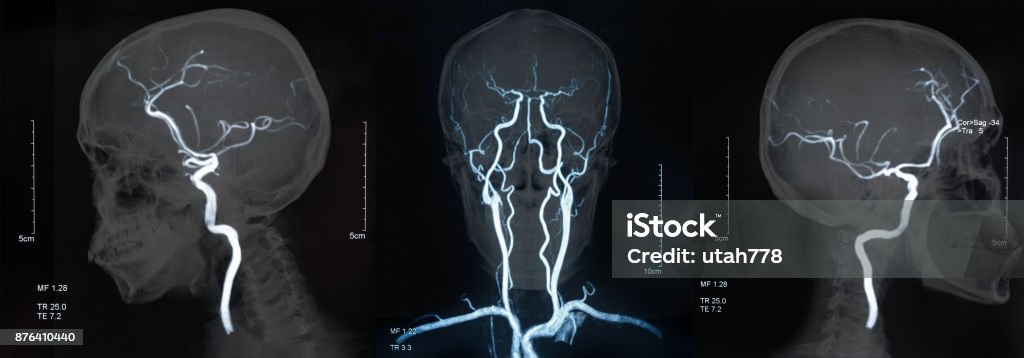 mri blood vessels in brain MRI of the blood vessel in the brain and cerebrovascular disease. brain stroke x-ray image. Stroke - Illness Stock Photo