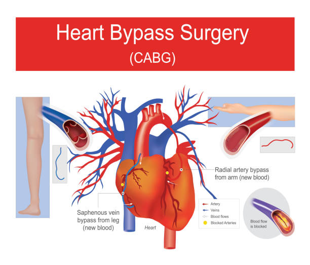 Heart bypass surgery. vector art illustration