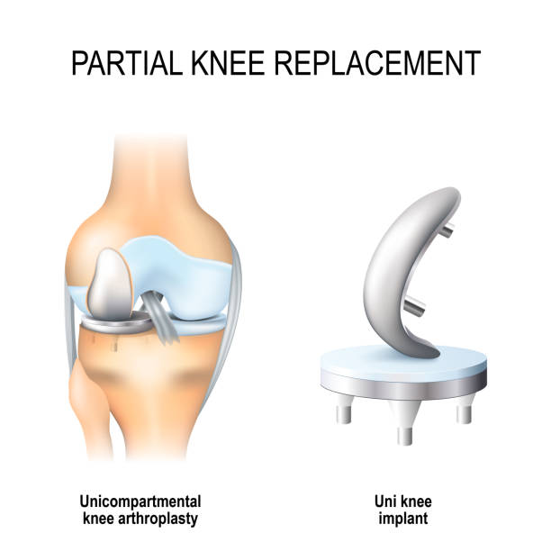 부분 무릎 교체입니다. - prosthetic equipment illustrations stock illustrations