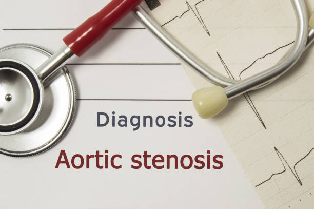 diagnosi cardiaca di stenosi aortica. sul posto di lavoro medico ci sono stetoscopio rosso, stampato su linea ecg su carta e un primo-up di penna sdraiato sul manuale medico, che indicava la diagnosi di stenosi aortica - aorta foto e immagini stock