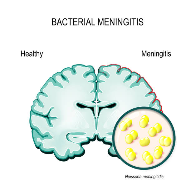 ilustrações, clipart, desenhos animados e ícones de meningite. cérebro humano e bactéria meningocócica - meningite