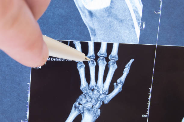 raio-x de digitalização das articulações mão, ossos e dedo. médico apontou em pequenas articulações de dedos, onde a patologia é detectada, como a artrite, artrite reumatoide, fratura. diagnóstico de enfermidades comuns por radiologia - computed - fotografias e filmes do acervo