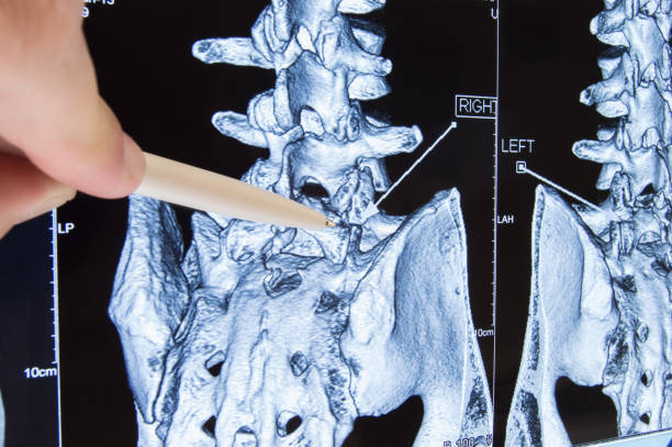 verificação da coluna lombossacra. médico apontou na área da lombar, onde a patologia é detectada, como radiculite, radiculopatia, hérnia, dor lombar. diagnóstico de doenças da coluna vertebral por radiologia - x ray image x ray back low - fotografias e filmes do acervo