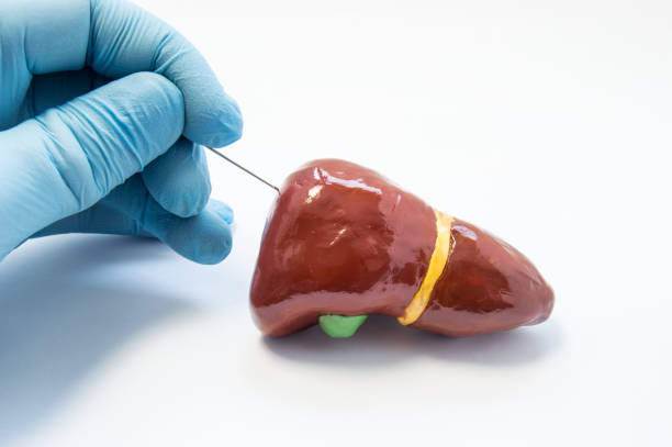 konzept-foto von leber-biopsie-verfahren. handchirurgie hält punktionsnadel und bereitet sich auf anatomischen 3d-modell des menschlichen leber zu durchbohren. diagnose von lebererkrankungen wie hepatitis cirrosis durch biopsie - biopsie stock-fotos und bilder