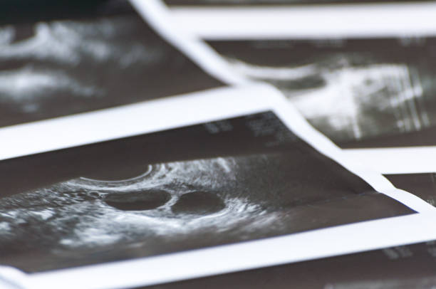 foto-aufnahmen von medizinischen ultraschall auch bekannt als diagnostische sonographie oder ultraschall des foliculometry in das protokoll das eco-programm in den prozess der hormonellen stimulation. ivf - sporttrainingsseminar stock-fotos und bilder