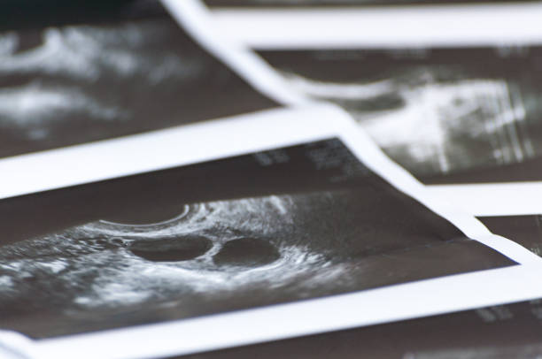 tomas fotográficas del ultrasonido médico también conocido como diagnóstico sonografía o ecografía de foliculometry en el protocolo del programa ecológico en el proceso de estimulación hormonal. fecundación in vitro - álava fotografías e imágenes de stock