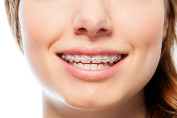 istock Happy woman's smile with orthodontic clear braces 877381636