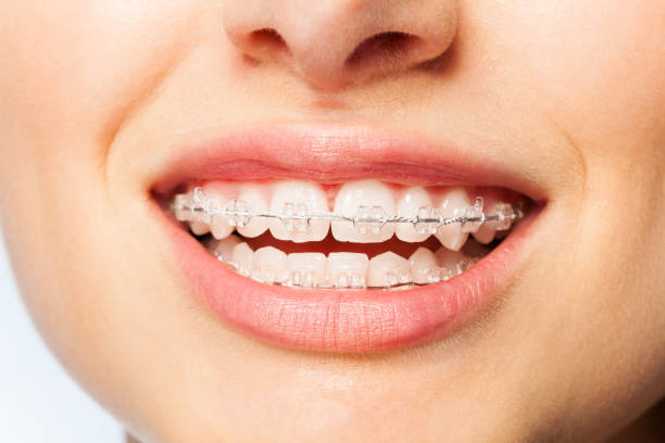 istock Healthy smile woman with clear brackets 877381724