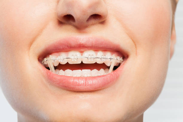 istock Female mouth with orthodontic elastics on braces 877382058