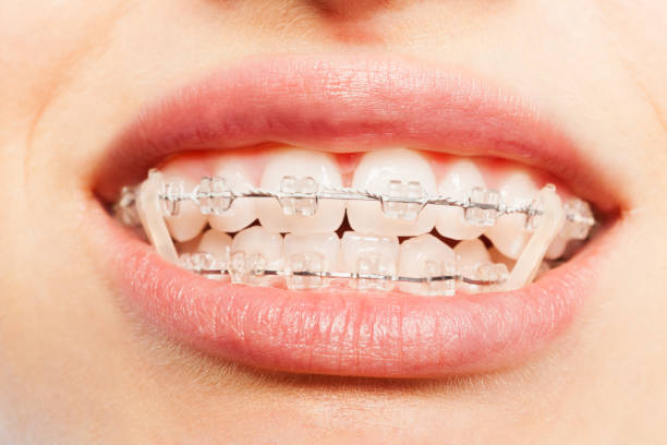 istock Teeth with dental braces and elastics full mouth 877382150