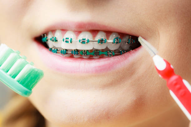istock Girl with teeth braces using interdental and traditional brush 878163998