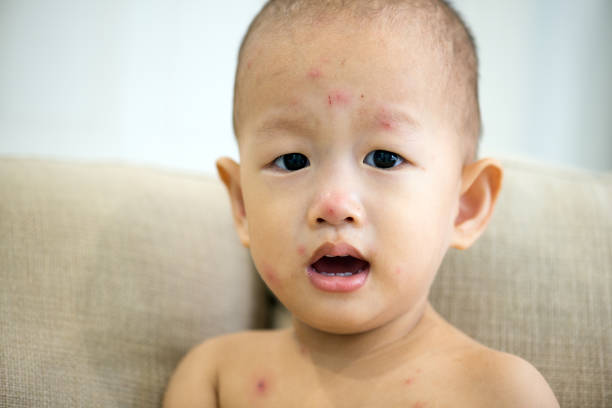 istock Asian baby boy with chicken pox 878173434