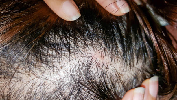 istock abscess on skin head 878970474