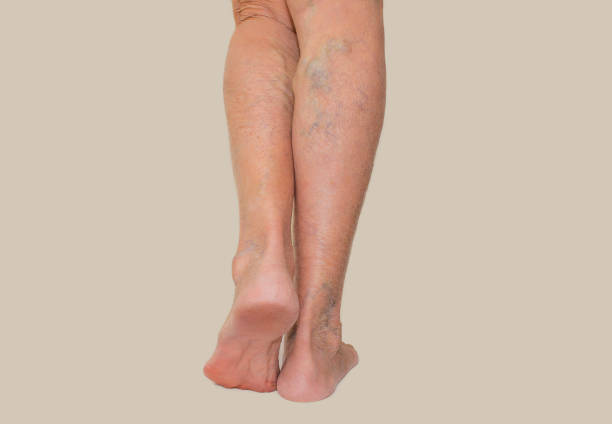 spataderen op een vrouwelijke benen - woman legs veins stockfoto's en -beelden
