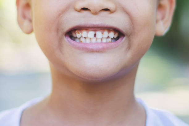 istock decayed teeth of Asian kid 879766560