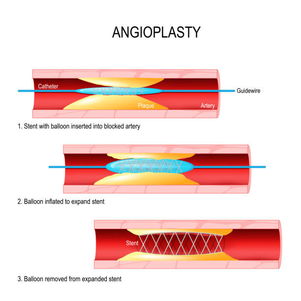 illustrations, cliparts, dessins animés et icônes de angioplastie. implantation de stents. - angioplasty