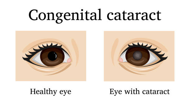 illustrazioni stock, clip art, cartoni animati e icone di tendenza di illustrazione della cataratta congenita - cataratta