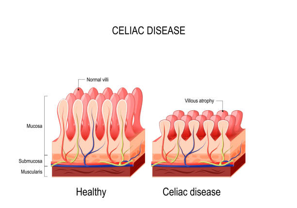 coeliac (celiac) 병입니다. 일반 villi 고 villous 쇠 약입니다. - mucosa stock illustrations