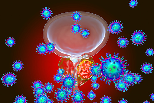 Conceptual image for viral ethiology of prostate cancer. 3D illustration showing viruses infecting prostate gland which develops cancerous tumor