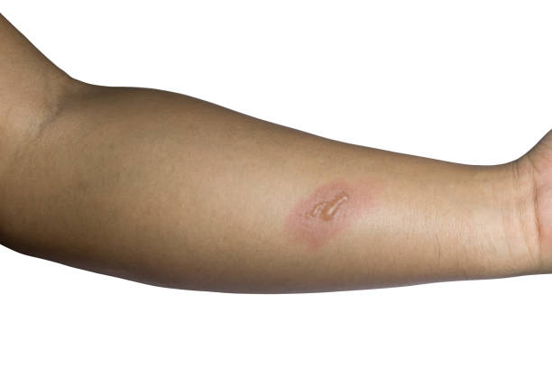 braccio con blister o bruciare la pelle su sfondo bianco - wound sunburned scar physical injury foto e immagini stock