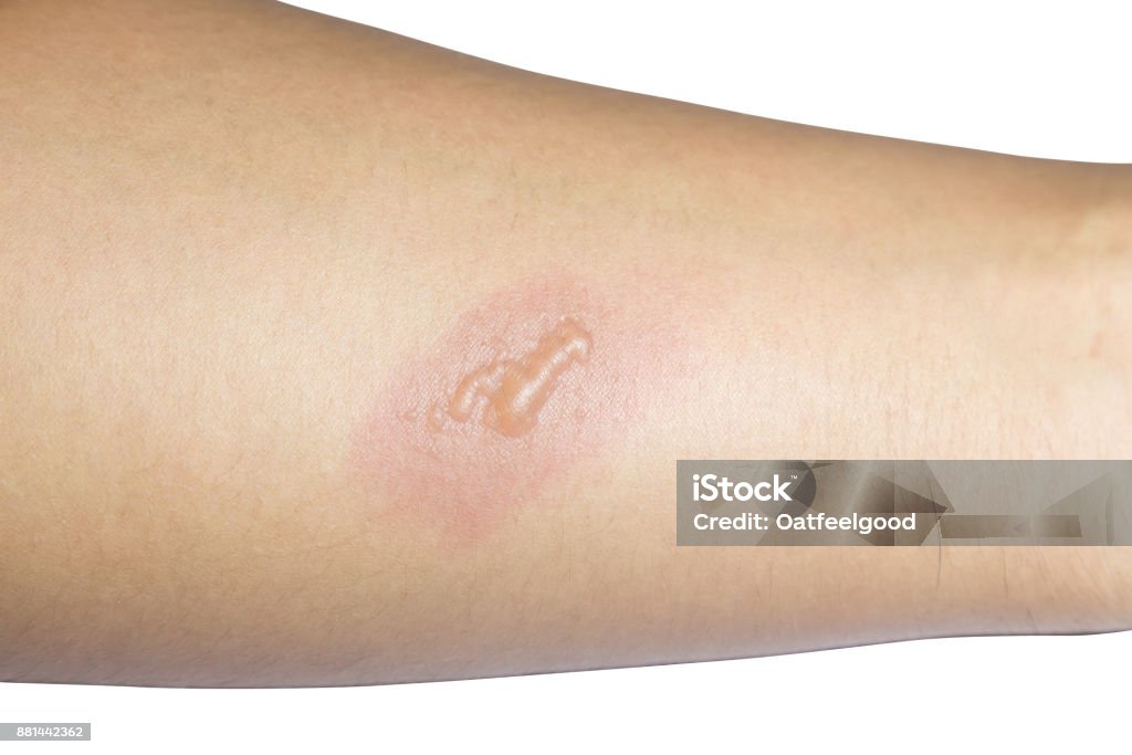 arm with blister or burn skin on white background Burning Stock Photo