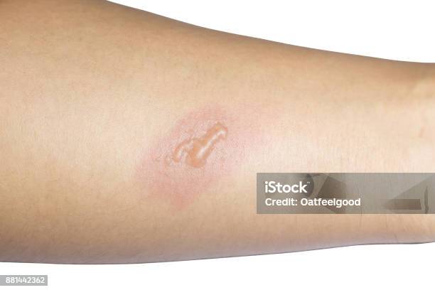 Arm With Blister Or Burn Skin On White Background Stock Photo - Download Image Now - Burning, Skin, Blister