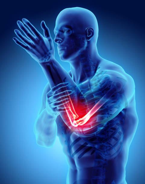 istock 3d illustration of human elbow injury. 881638954
