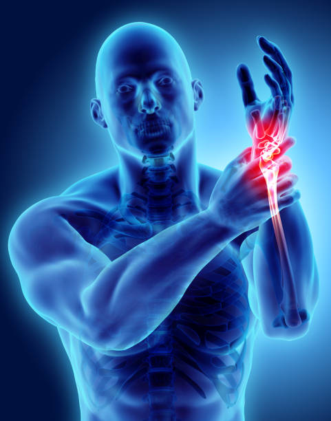istock Wrist painful - skeleton x-ray. 881644682