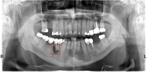 Dental x-ray: two teeth roots with inflammation Panoramic dental x-ray of human teeth. Two teeth darker roots with inflammation (gangrene) in the red frame. gangrene stock pictures, royalty-free photos & images