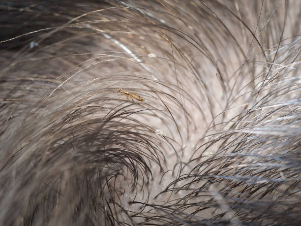 Lice In Hair. Macro
