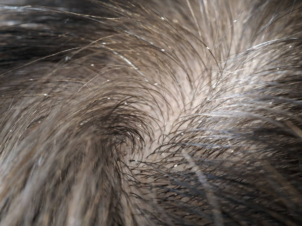 läuse im haar. makro - kopflaus stock-fotos und bilder